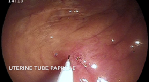 Subfertility_Catheter Left Side of Uterine Tube Papilla