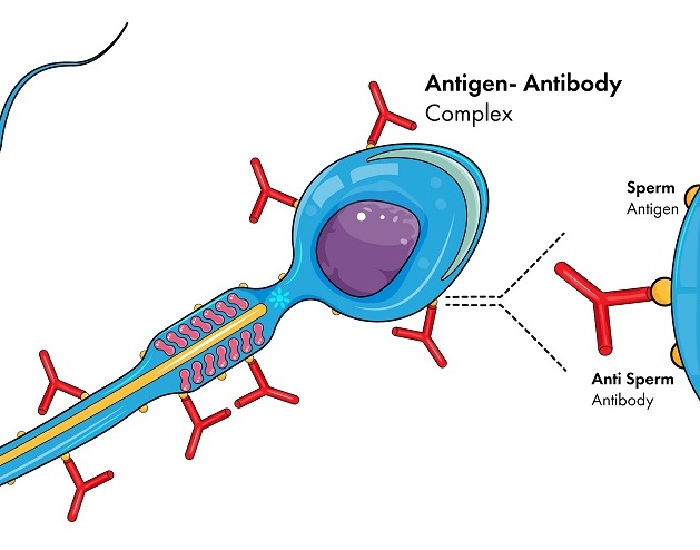 Antisperm Antibody Photo 022222